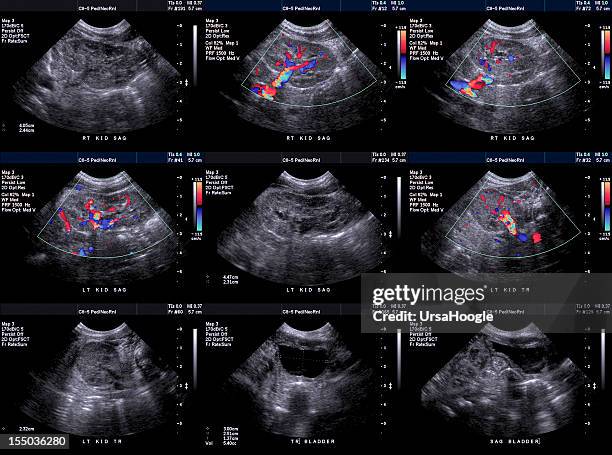 ultrasound of newborn kidneys and bladder - ultrasound stock pictures, royalty-free photos & images