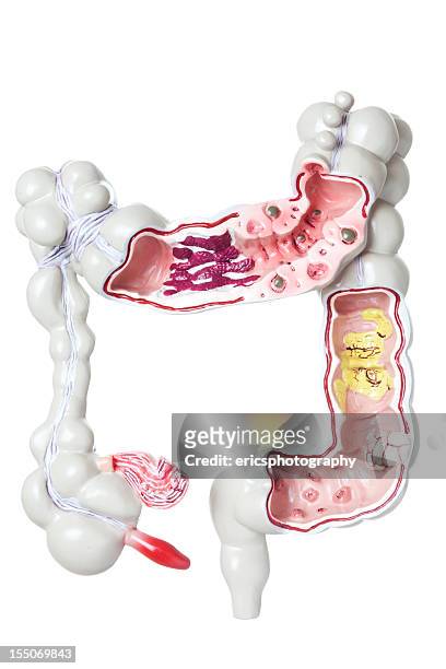 intestino grosso com patologias - appendicitis imagens e fotografias de stock