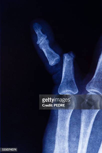 x-ray of broken finger bone - deformed hand stock-fotos und bilder