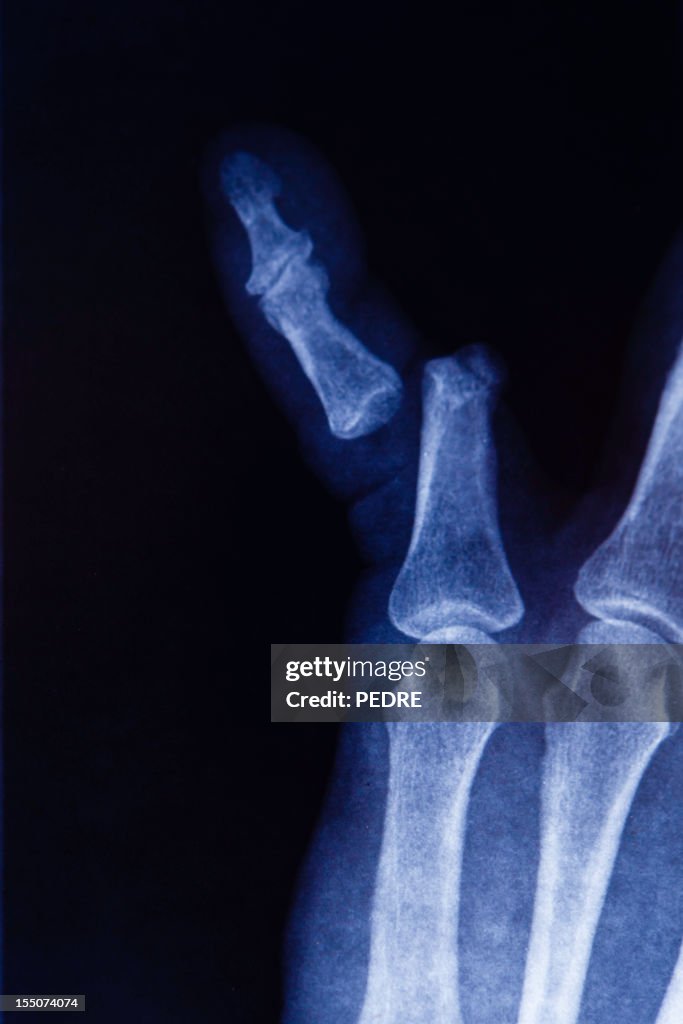 X-Ray de dedo quebrado osso