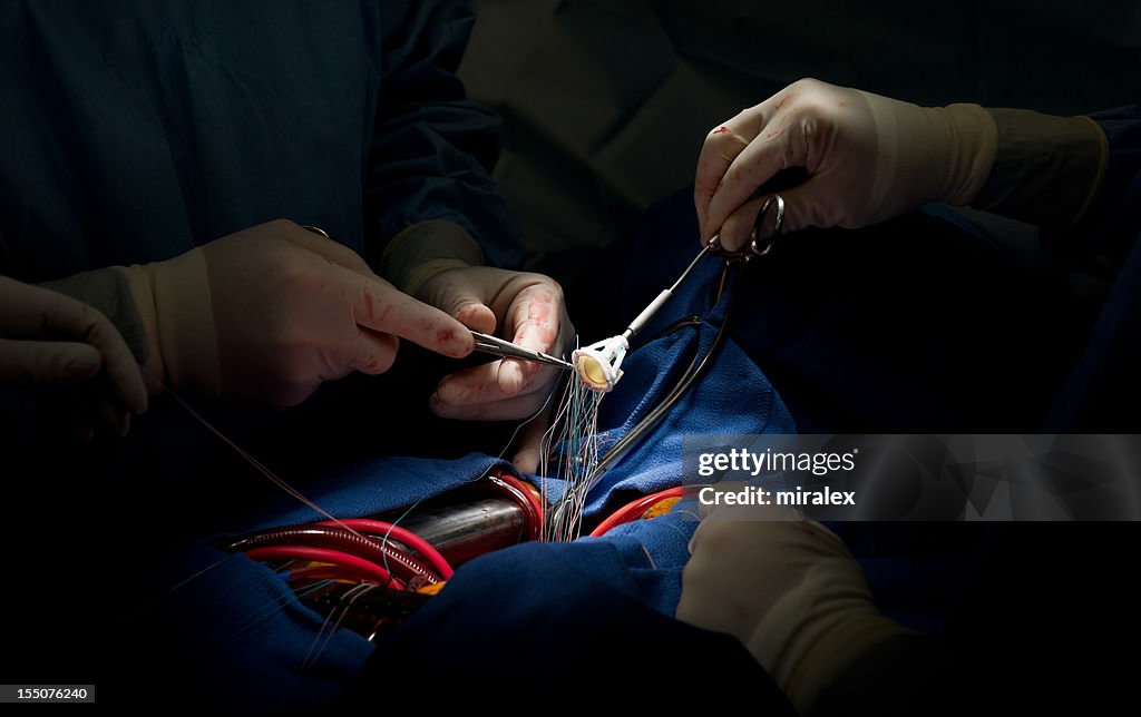 Heart Surgery Aortic Valve Replacement with Xenograft