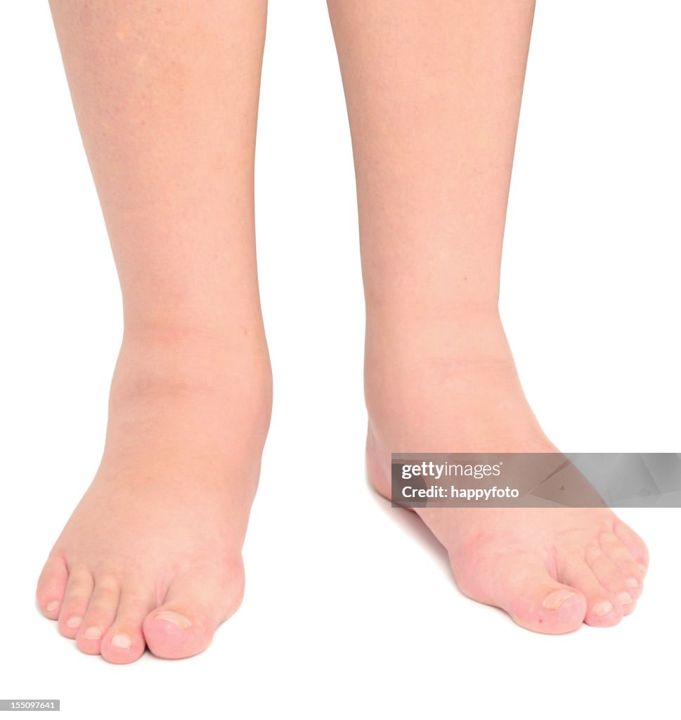 Leg Edema Resolution Edema High-Res Stock Photo - Getty Images