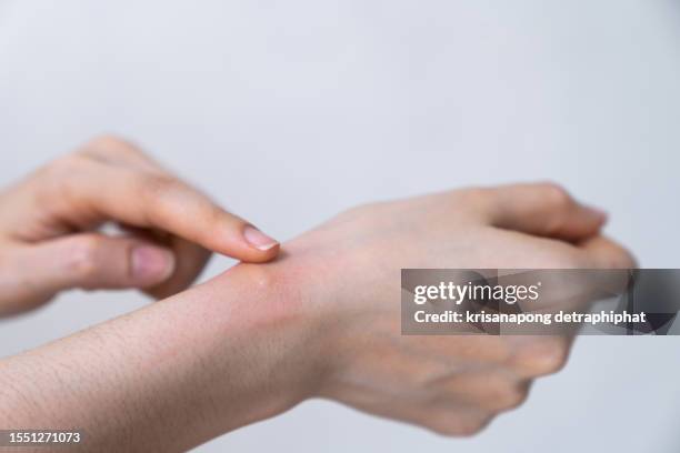 hand pain, swollen hands - dengue 個照片及圖片檔