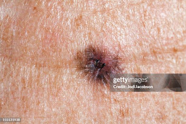 medicina: lentigo maligna melanoma - complexion foto e immagini stock