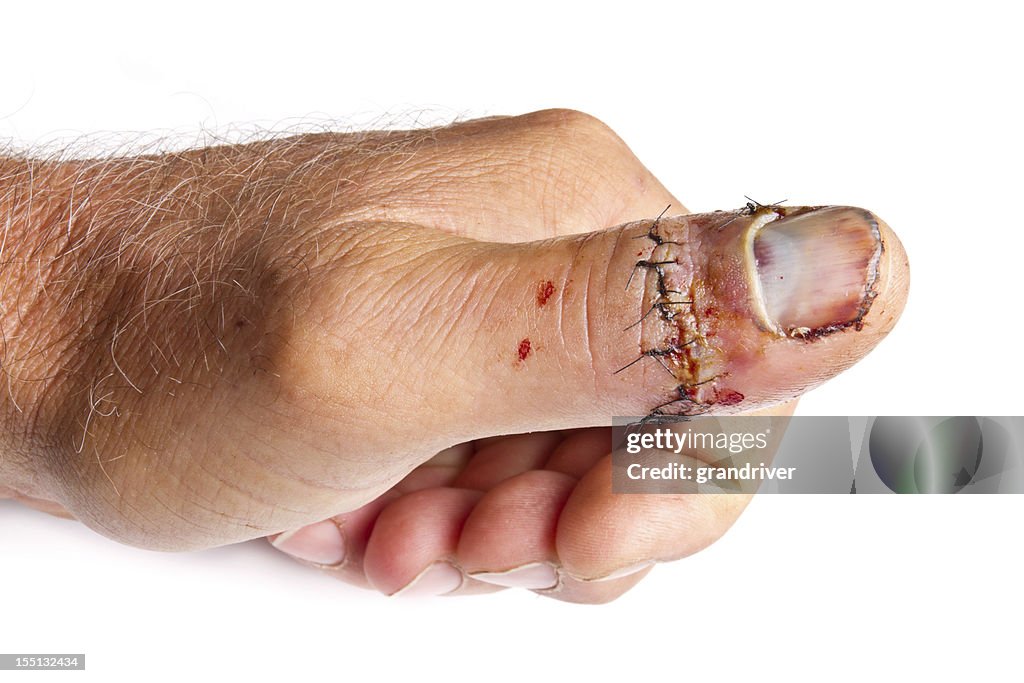 Injured Thumb
