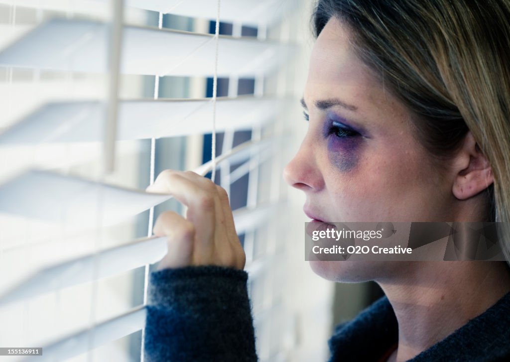 Frau mit einer Black Eye