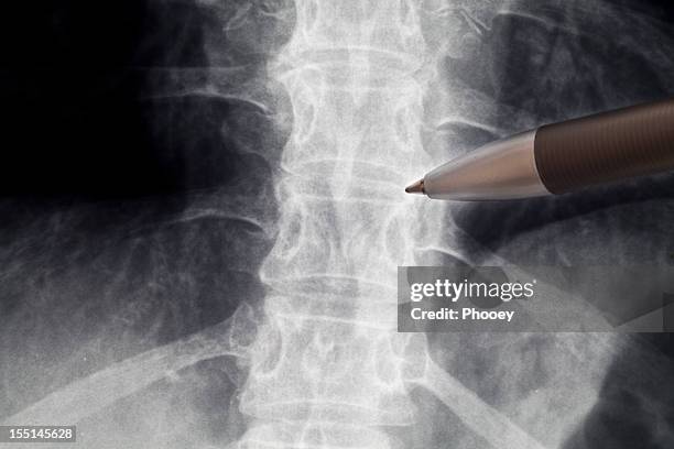 radiografía de la columna vertebral - columna fotografías e imágenes de stock