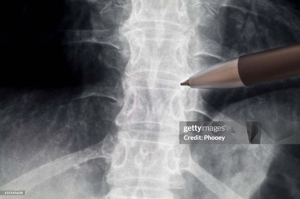 Spine radiography