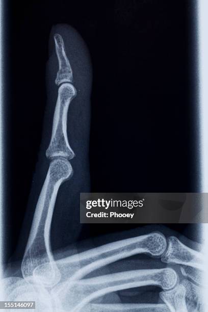 3 fingers radiography - little finger stock pictures, royalty-free photos & images