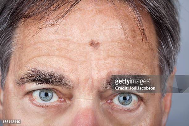 man with a lentigo maligna melanoma series - blue eyes man stock pictures, royalty-free photos & images