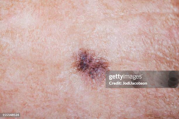 lentigo maligna melanoma - mole stockfoto's en -beelden