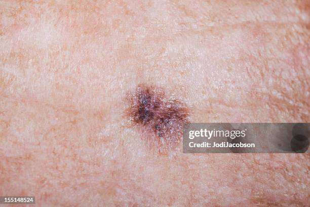 lentigo maligna melanoma - complexion stock pictures, royalty-free photos & images