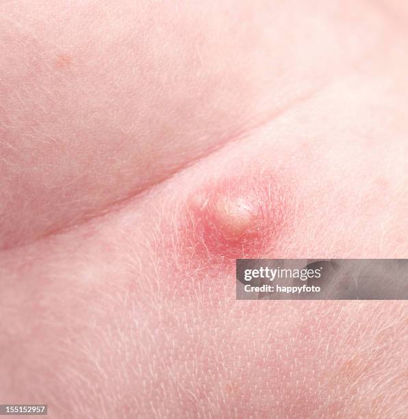 pimple - abscess stockfoto's en -beelden