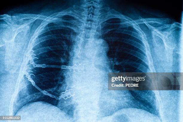 x-ray of a curved vertebral column - skolios bildbanksfoton och bilder