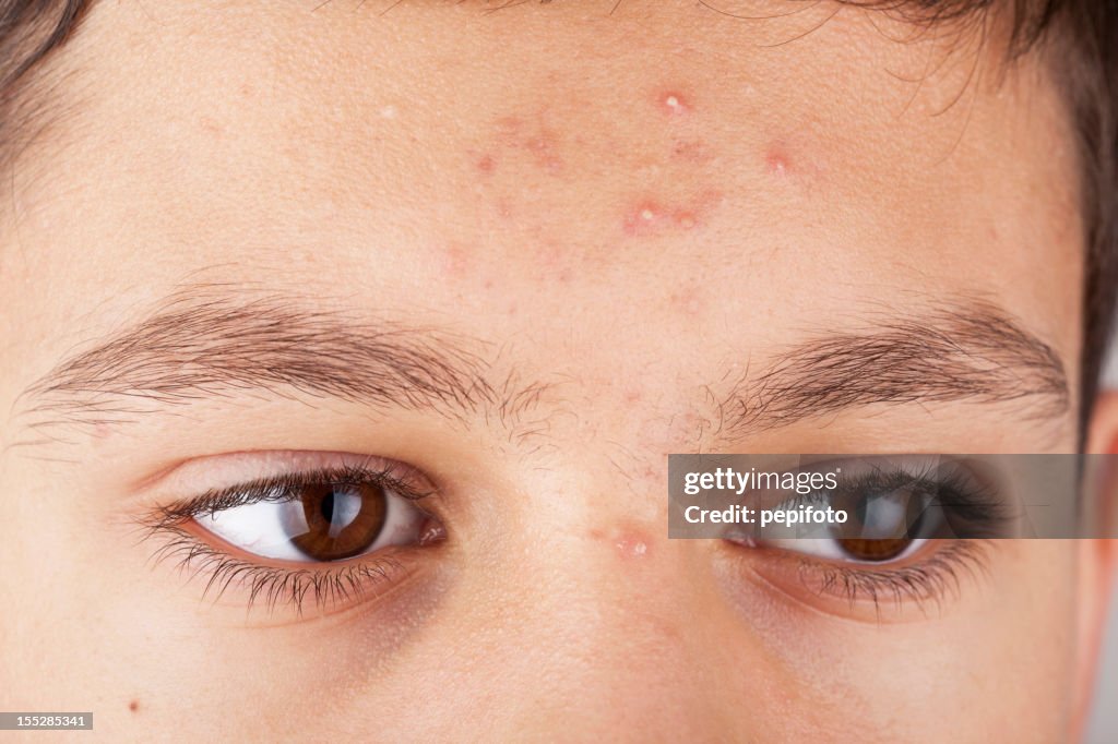 Teenage skin problems