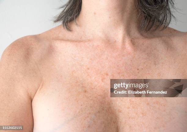 skin aging, spots on body, neckline, protects skin from sunburn, pigmentation on chest, freckles on chest. - hyperpigmentation stockfoto's en -beelden