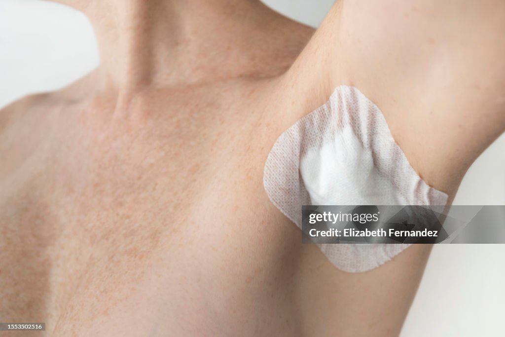 Post-surgical epidermal cyst excision in female armpit