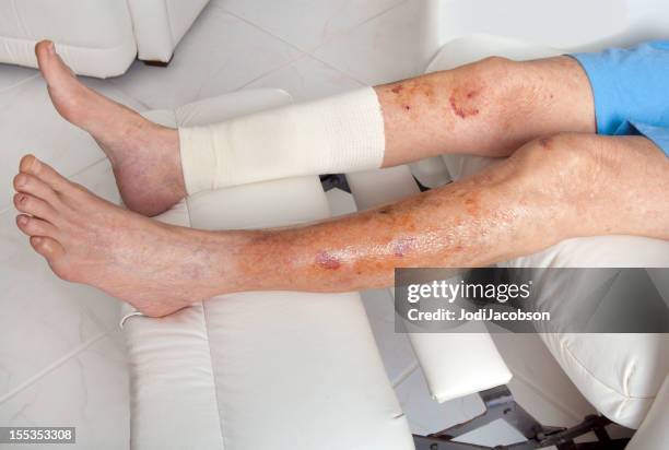 medical: senior with thin skin injury - ace bandage stock pictures, royalty-free photos & images