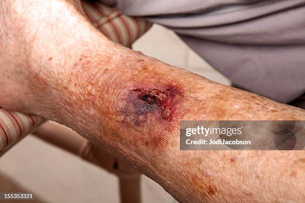 medical: senior with thin skin injury - hemorrhage stock pictures, royalty-free photos & images