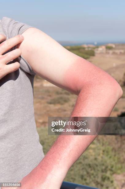 aguda quemaduras de sol - raya del bronceado fotografías e imágenes de stock