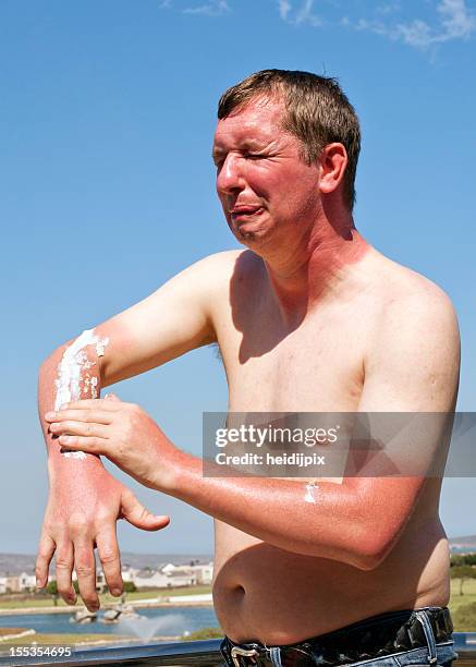 skin burn - sunburned stockfoto's en -beelden