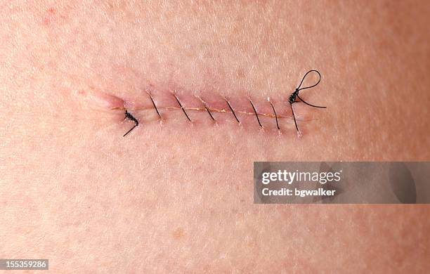 stitches - surgery stitches stock pictures, royalty-free photos & images