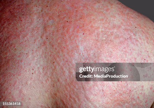 Ripe Rash Rash High-Res Stock Photo - Getty Images