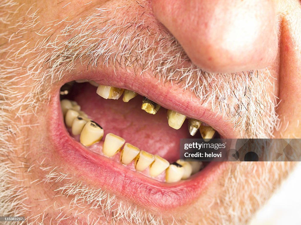 Bad Teeth High-Res Stock Photo - Getty Images