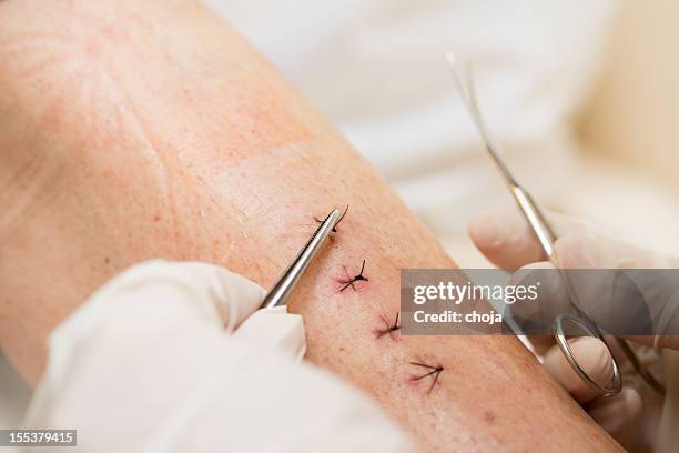 enfermeira trabalhando com paciente depois de perna quebrada operação - suture - fotografias e filmes do acervo