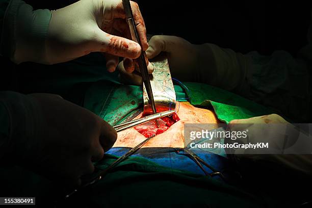hernia inguinal de la cirugía - hernia mesh fotografías e imágenes de stock