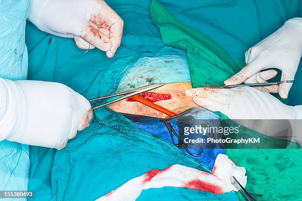 鼠径ヘルニア手術 - hernia inguinal ストックフォトと画像
