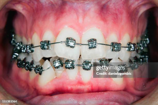 orthodontic tratamiento con recesion gingival - odontología cosmética fotografías e imágenes de stock