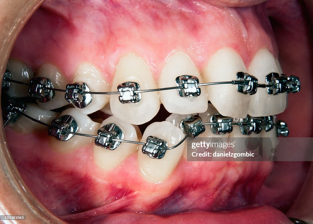 Em ortodontia tratamento com Recesion gengival
