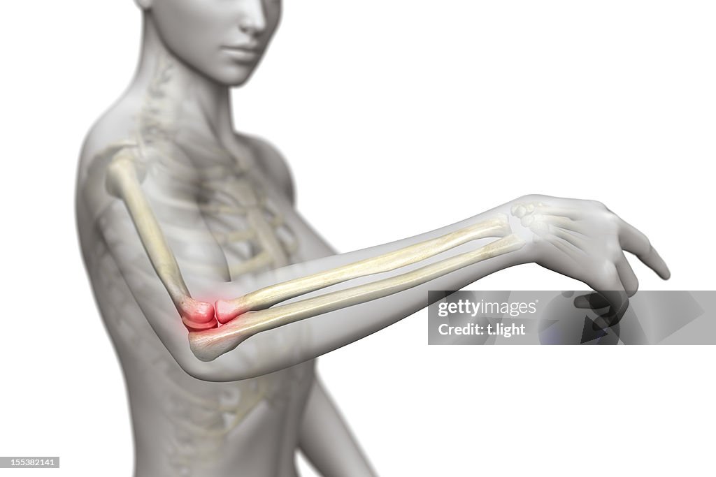 Tennis elbow (epicondylitis)