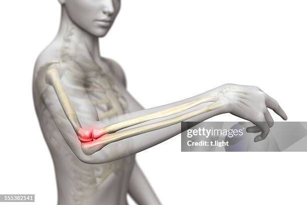 tennis elbow (epicondylitis) - människolem bildbanksfoton och bilder