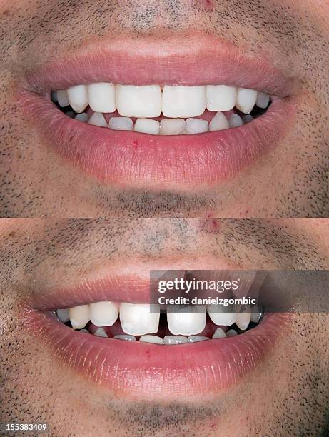 before & after smile design - before and after stock pictures, royalty-free photos & images