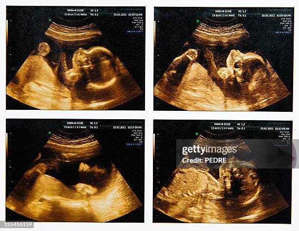 compilation of four fetus ultrasounds - medical scanning equipment stock pictures, royalty-free photos & images