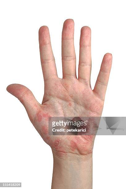 schuppenflechte offene hand - deformed hand stock-fotos und bilder