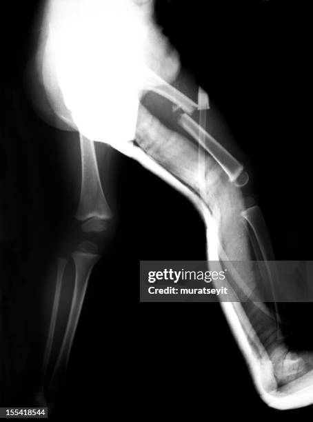 broken keg of a child - femur stock pictures, royalty-free photos & images