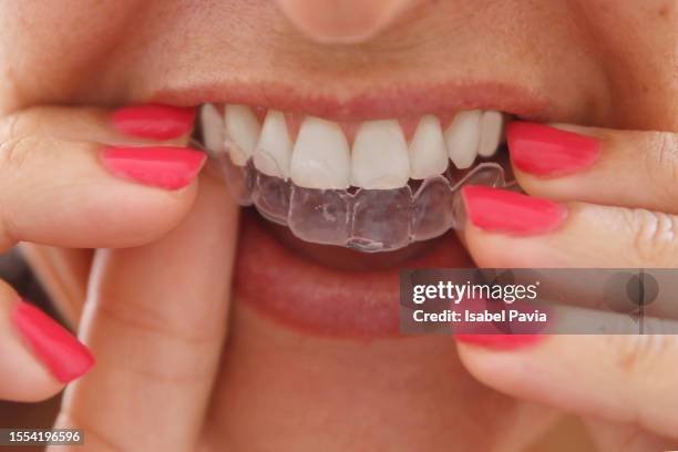 close-up of young woman wearing clear invisible orthodontics - bleek gezicht stockfoto's en -beelden