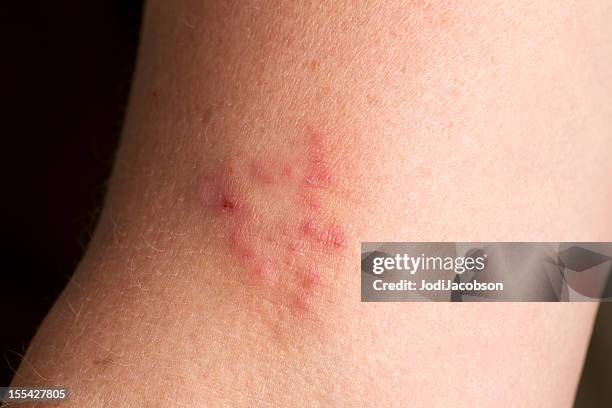 medical hautausschlag: vesicular dermatitis - dermatophyt stock-fotos und bilder