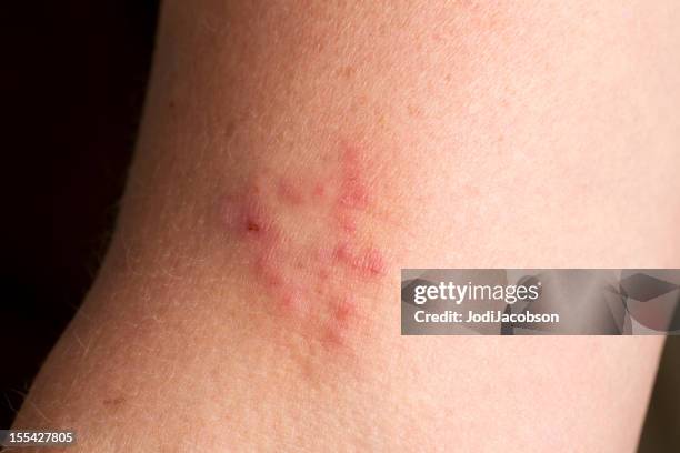 medical skin condition: vesicular dermatitis - skin fungus stock pictures, royalty-free photos & images