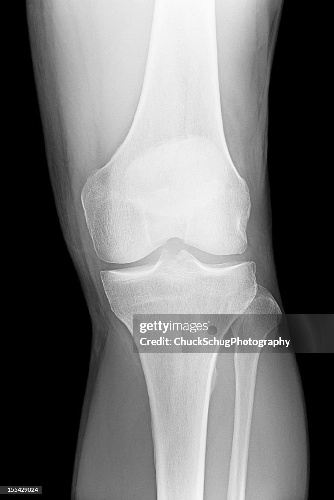 Knee X-Ray Human Leg Bone Anatomy
