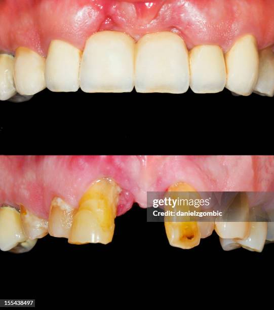 before & after smile design - before and after teeth stock pictures, royalty-free photos & images