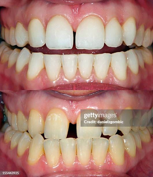 image of straight white teeth and crooked yellow teeth - before and after teeth stock pictures, royalty-free photos & images