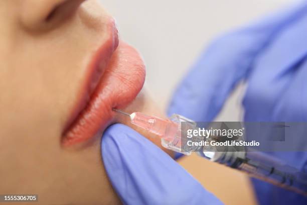 plastic surgery - lip injections stockfoto's en -beelden