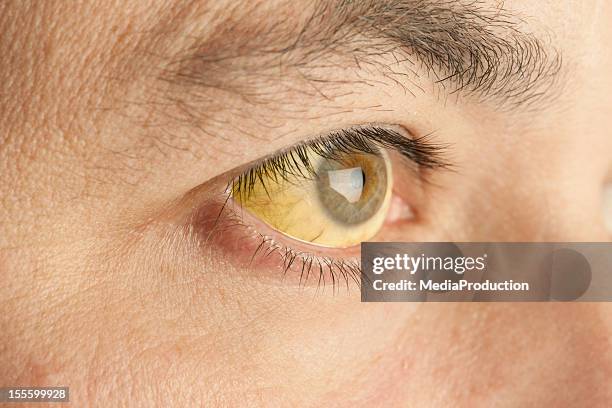 jaundice - bilirubine stockfoto's en -beelden