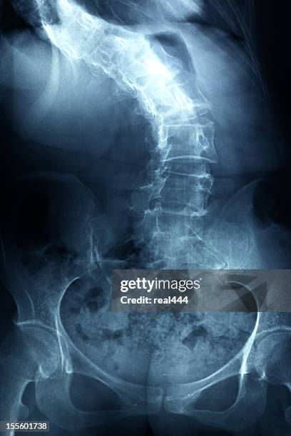 x-ray image human spine - spinal cord injury stock pictures, royalty-free photos & images