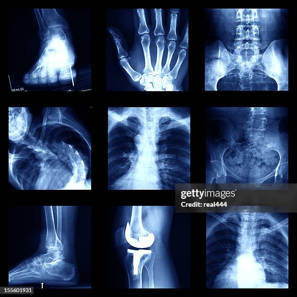 x-ray - coluna vertebral humana imagens e fotografias de stock