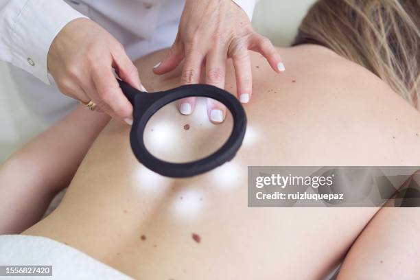 female doctor examining moles of a patient with a magnifying glass - leverfläck bildbanksfoton och bilder